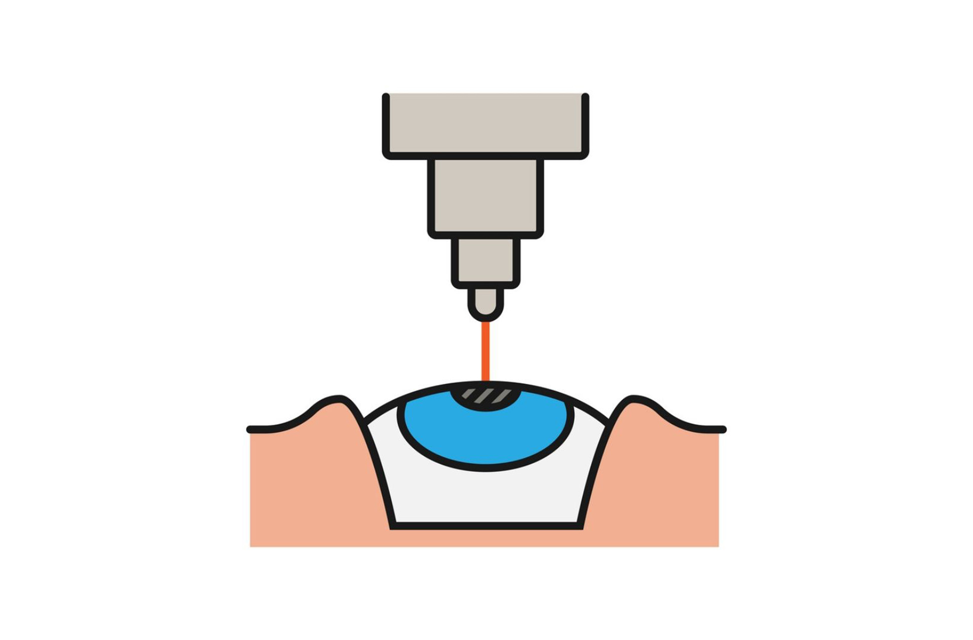 Laser Eye Surgery | Bookingmedicine.com